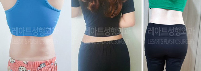 post_81_02_abdominal_liposuction_04