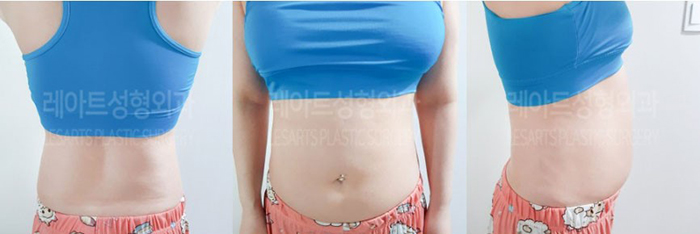post_81_02_abdominal_liposuction_05