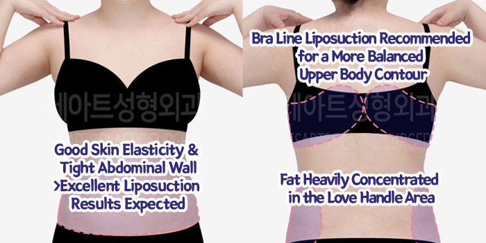 post_81_02_abdominal_liposuction_06