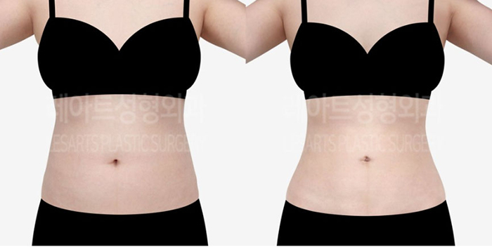 post_81_02_abdominal_liposuction_07