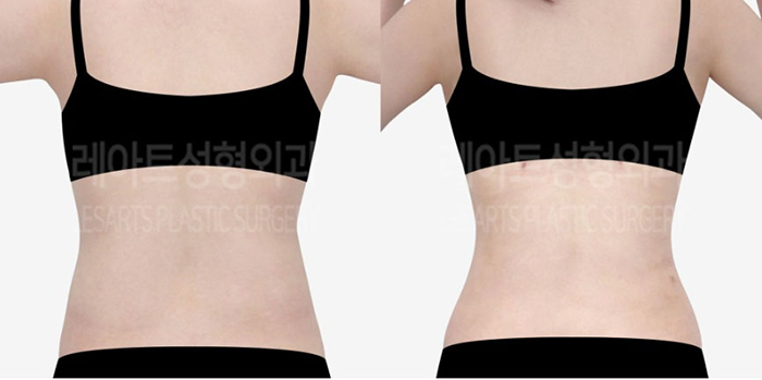 post_81_02_abdominal_liposuction_08