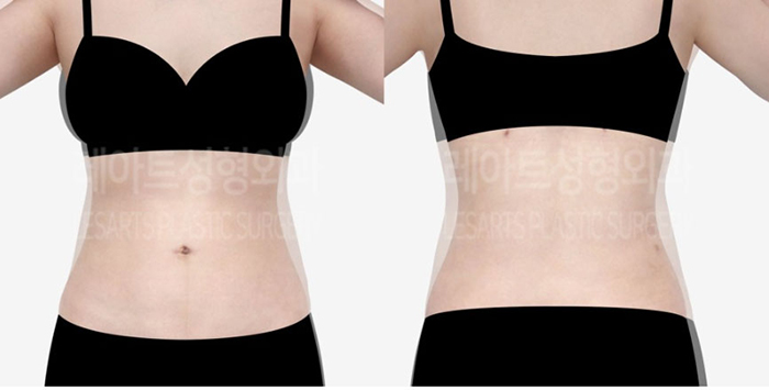post_81_02_abdominal_liposuction_09