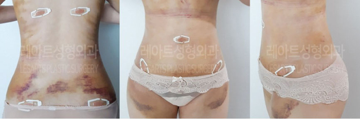 post_81_02_abdominal_liposuction_10