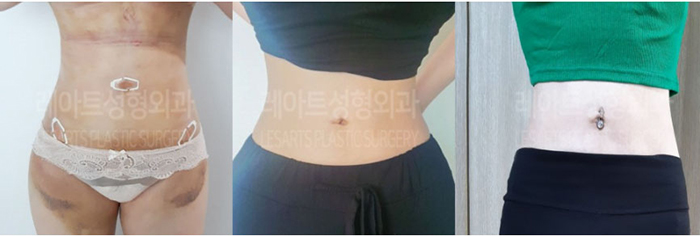 post_81_02_abdominal_liposuction_11