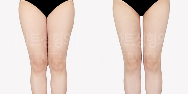 post_82_01_thigh_liposuction_thumbnail