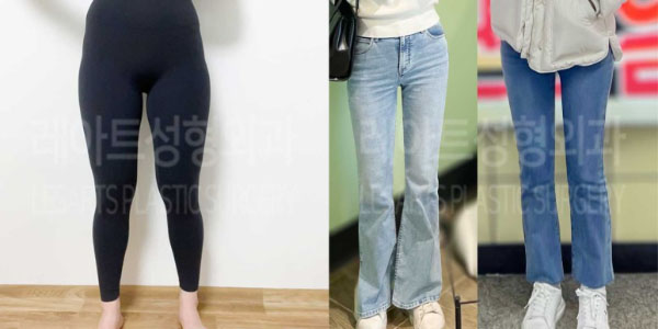 post_82_02_thigh_liposuction_01