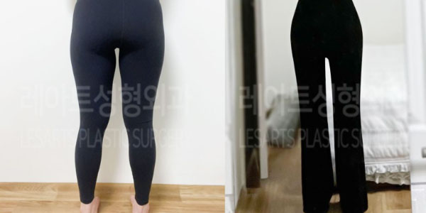 post_82_02_thigh_liposuction_02