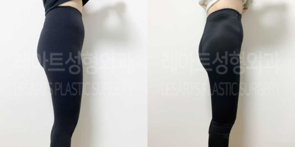 post_82_02_thigh_liposuction_03