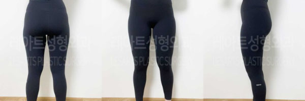 post_82_02_thigh_liposuction_04
