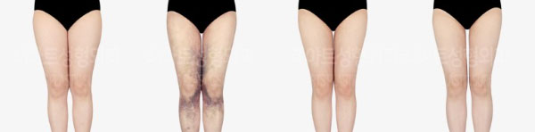 post_82_02_thigh_liposuction_06