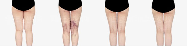 post_82_02_thigh_liposuction_07