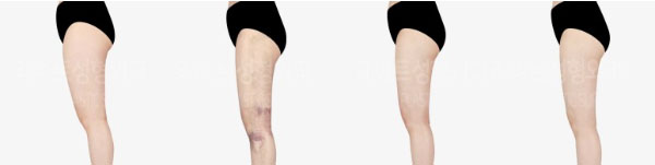 post_82_02_thigh_liposuction_08