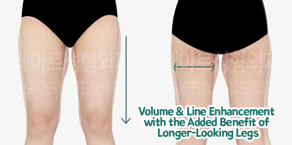 post_82_02_thigh_liposuction_09