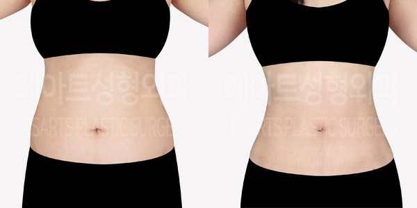 post_83_01_abdominal_liposuction_thumbnail