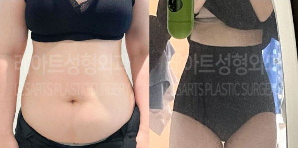 post_83_02_abdominal_liposuction_01