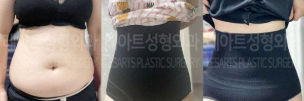 post_83_02_abdominal_liposuction_02