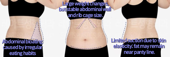 post_83_02_abdominal_liposuction_04
