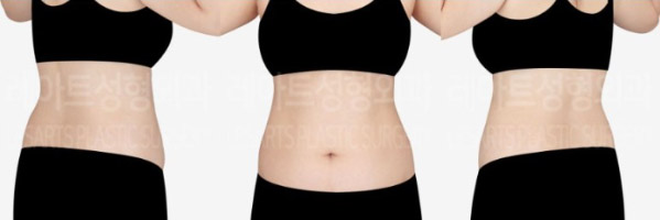 post_83_02_abdominal_liposuction_06