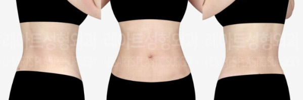 post_83_02_abdominal_liposuction_07