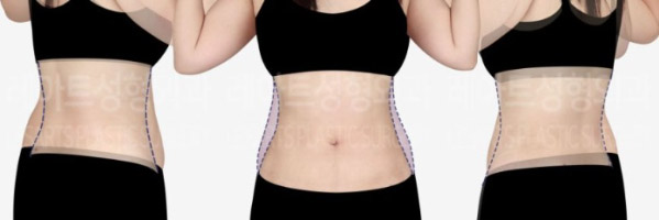 post_83_02_abdominal_liposuction_08