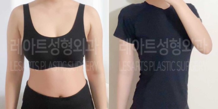 post_84_02_arm_liposuction_01