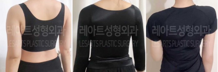 post_84_02_arm_liposuction_02