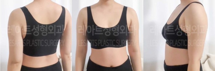 post_84_02_arm_liposuction_04