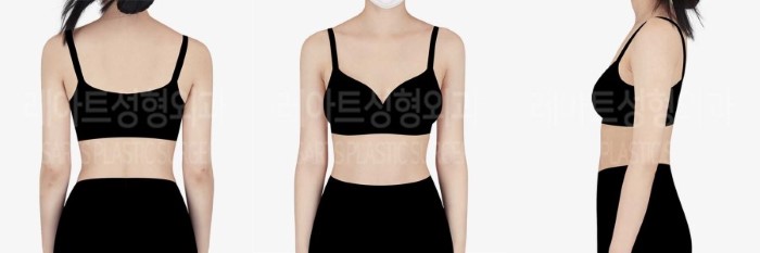 post_84_02_arm_liposuction_08