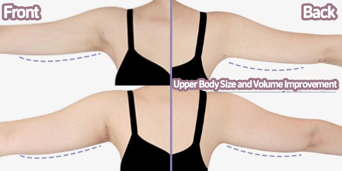 post_84_02_arm_liposuction_10