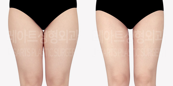 thigh_liposuction_Chanel -Line thumbnail