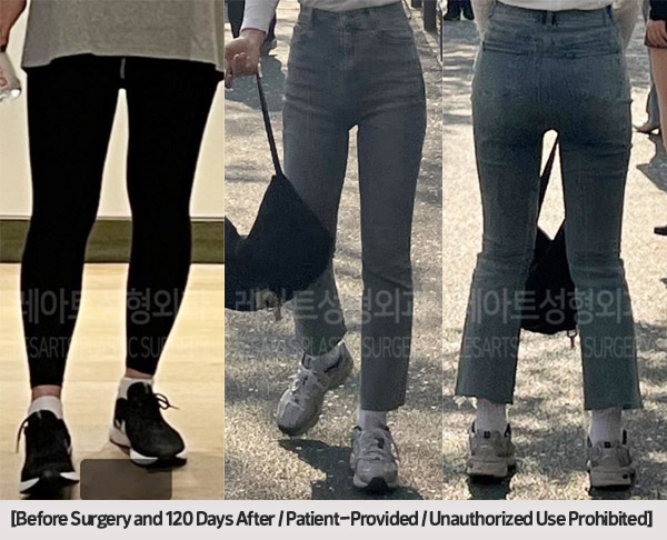 post_85_02_thigh_liposuction_01