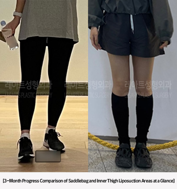 post_85_02_thigh_liposuction_03
