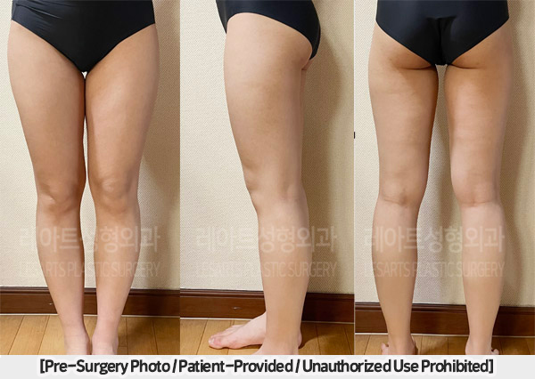 post_85_02_thigh_liposuction_04