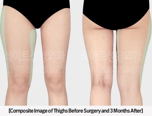 post_85_02_thigh_liposuction_06