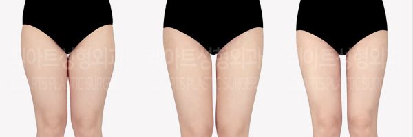 post_85_02_thigh_liposuction_07