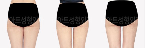 post_85_02_thigh_liposuction_08