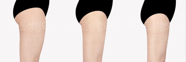 post_85_02_thigh_liposuction_09