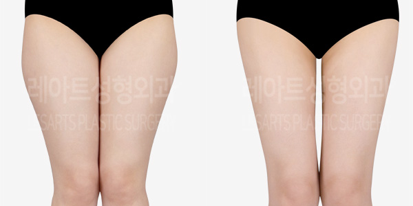 thigh_iposuction_thumbnail_01_231215