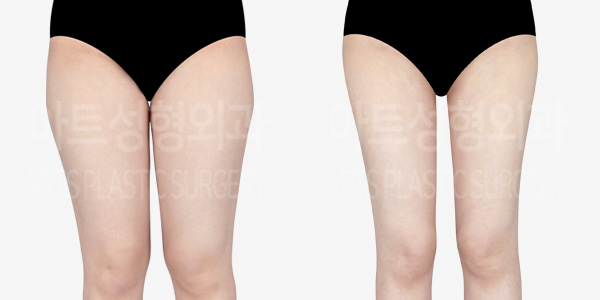 thigh_liposuction_01_thumbnail