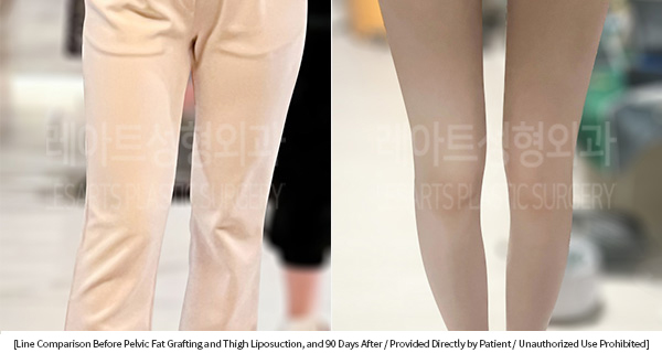 thigh_liposuction_02_01