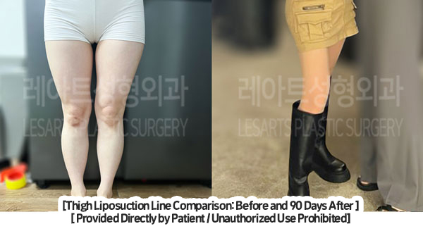 thigh_liposuction_02_01