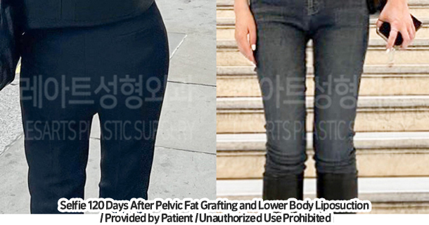 thigh_liposuction_02_01_231215