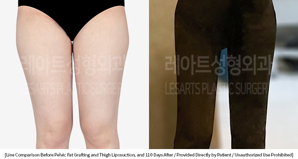 thigh_liposuction_02_02