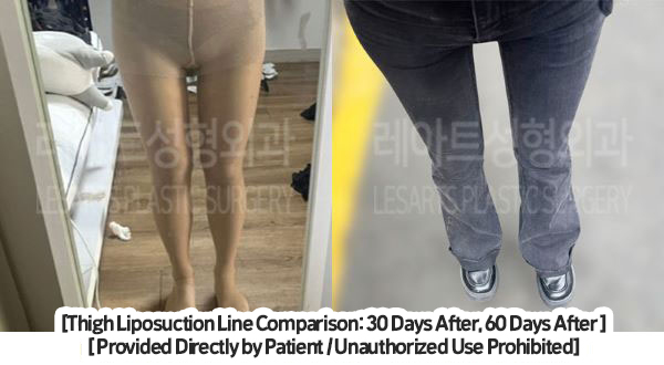 thigh_liposuction_02_02