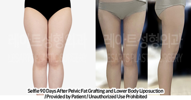 thigh_liposuction_02_02_231215