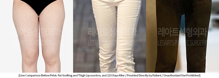 thigh_liposuction_02_03