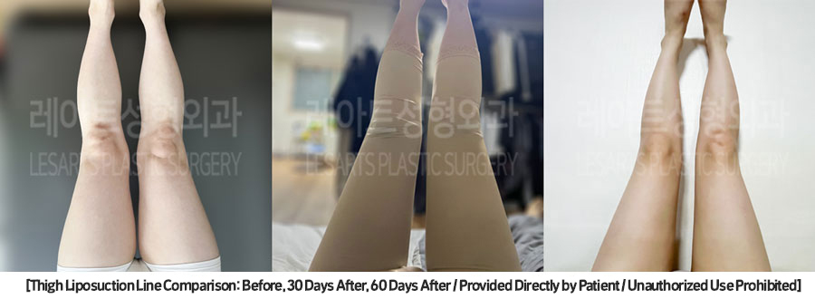 thigh_liposuction_02_03
