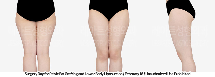 thigh_liposuction_02_03_231215