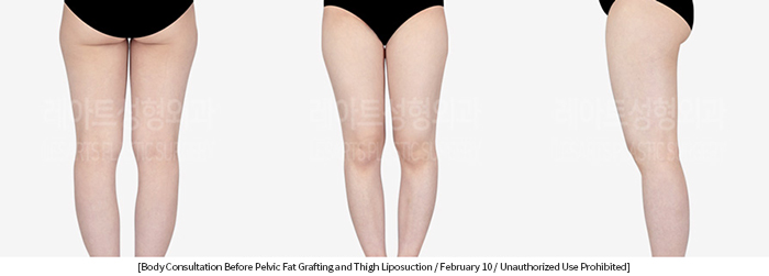 thigh_liposuction_02_04