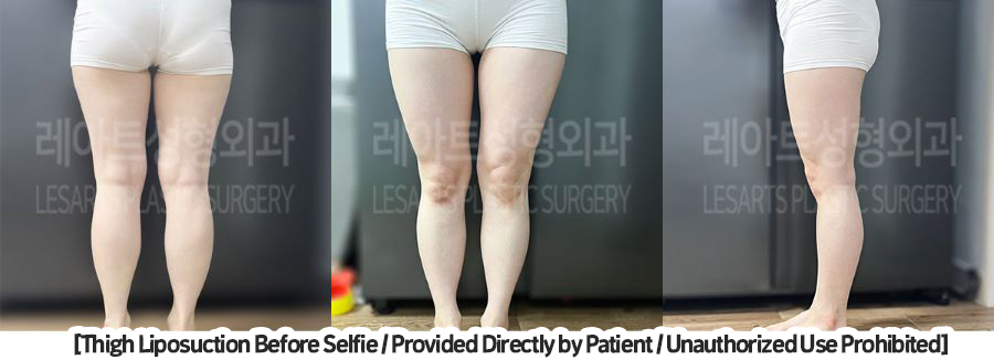 thigh_liposuction_02_04
